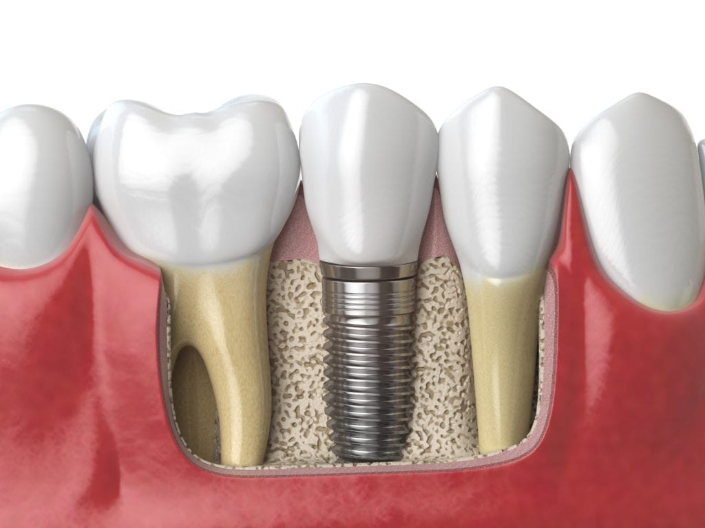 affordable dental implants at Northeast Philadelphia implant dentistry