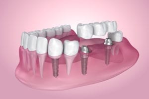 implant-supported dental bridge in northeast Philadelphia, PA