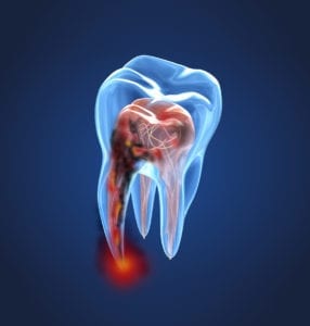 Root canals in Philadelphia, PA