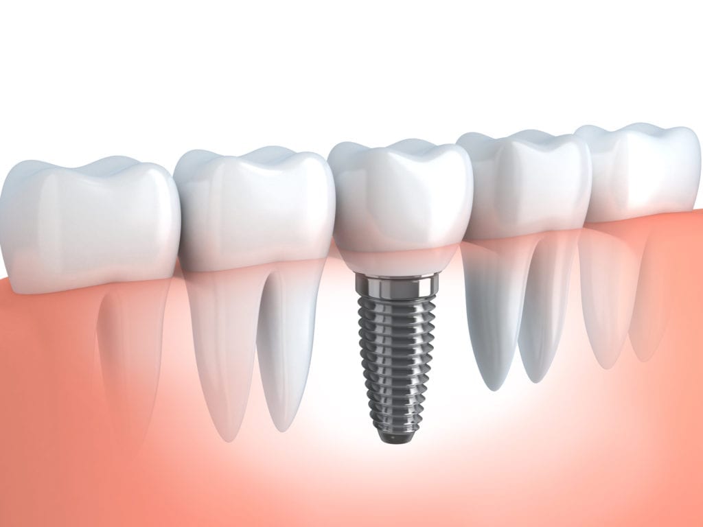 single dental implant in northeast Philadelphia for one missing tooth