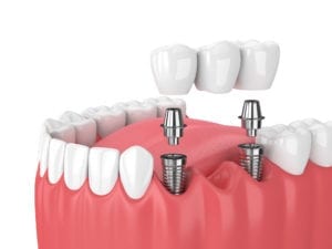 multiple dental implants northeast philadelphia