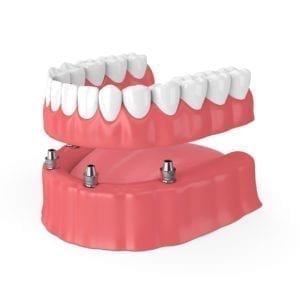 Implant Supported Full Denture in Northeast Philadelphia, PA