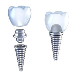 Northeast Philadelphia implant dentistry for affordable dental implants