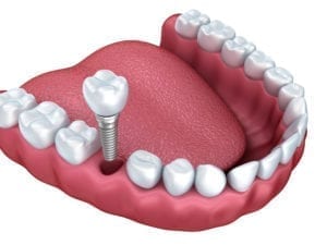 Dental Implant Services in Northeast Philadelphia, PA