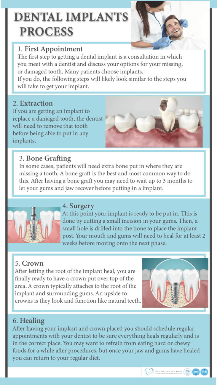 Dental Implants Process Infographic