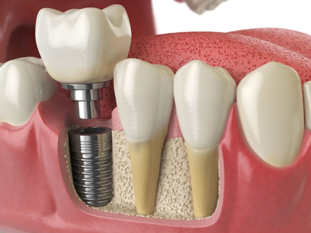 dental implants northeast philadelphia
