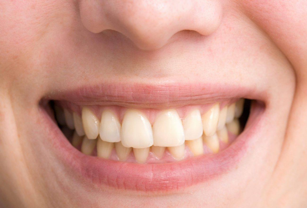 Stained teeth treatments in Northeast Philadelphia