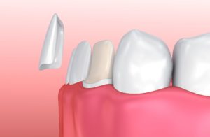 porcelain veneers benefits Northeast Philadelphia Pennsylvania