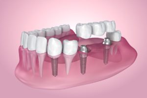 implant dentistry Northeast Philadelphia Pennsylvania