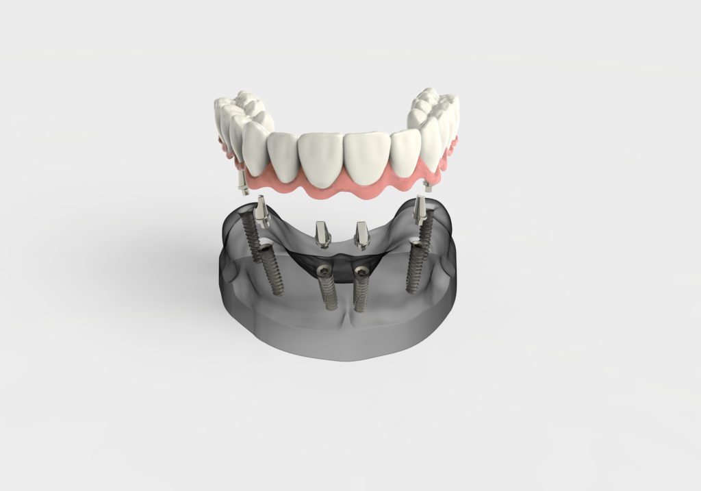 Philadelphia dentist compares dental implants vs dentures