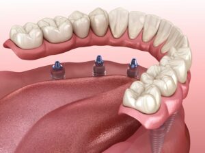 Your Dental Implant Recovery