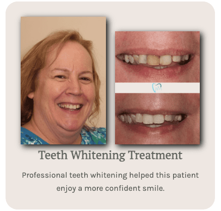 Dental patient before and after teeth whitening in Philadelphia
