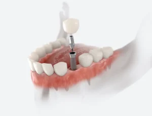 Mini Dental Implants: A Smaller Solution in Philadelphia, PA